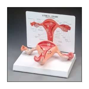 Anatomical Chart Company   Uterus, Ovaries Model w/Pathologies:  