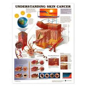  Understanding Skin Cancer Anatomical Chart Paper Unmounted 